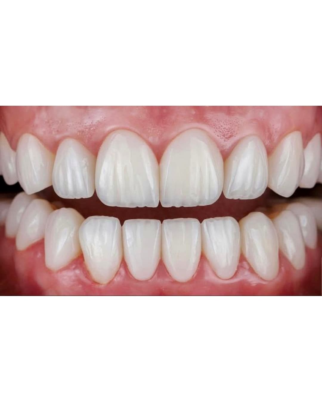 صورة فينير الأسنان لحالة تجميل ابتسامة في 6 أكتوبر